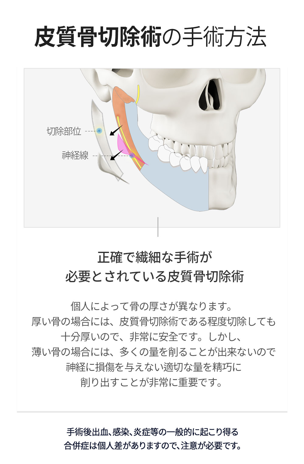 Lamiche Plastic Surgery 皮質骨切除