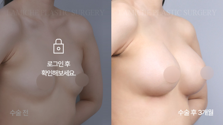 breast-enlargement-bna1-1-