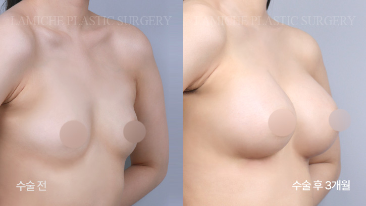 breast-enlargement-bna1-1