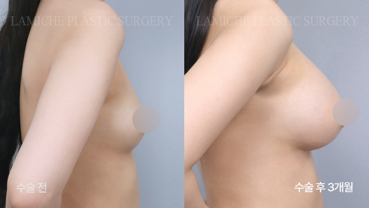 breast-enlargement-bna1-3