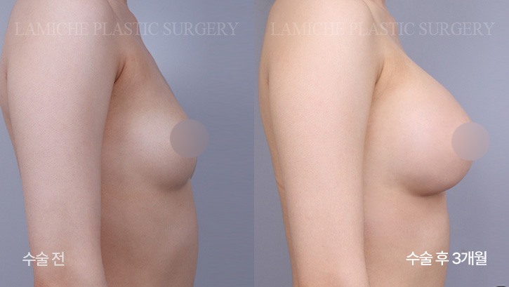 breast-enlargement-bna2-1