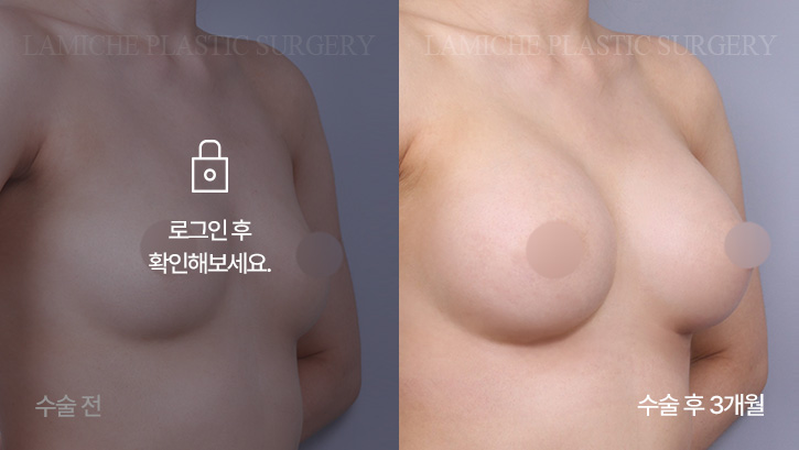 breast-enlargement-bna2-2-