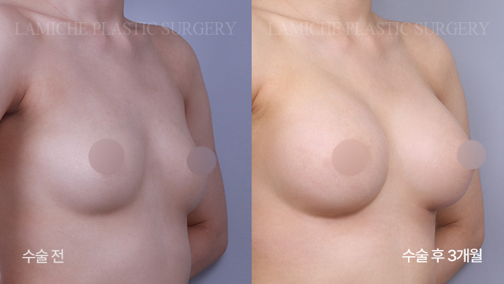 breast-enlargement-bna2-2