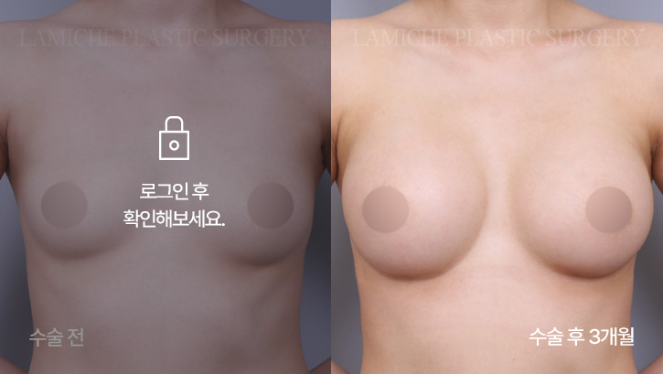 breast-enlargement-bna2-3-