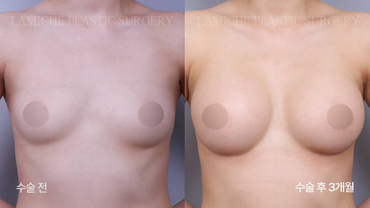 breast-enlargement-bna2-3