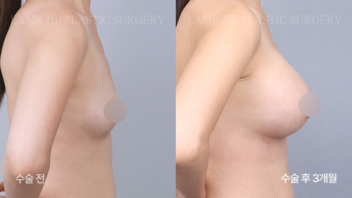 breast-enlargement-bna3-1