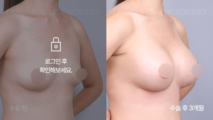 breast-enlargement-bna3-2-