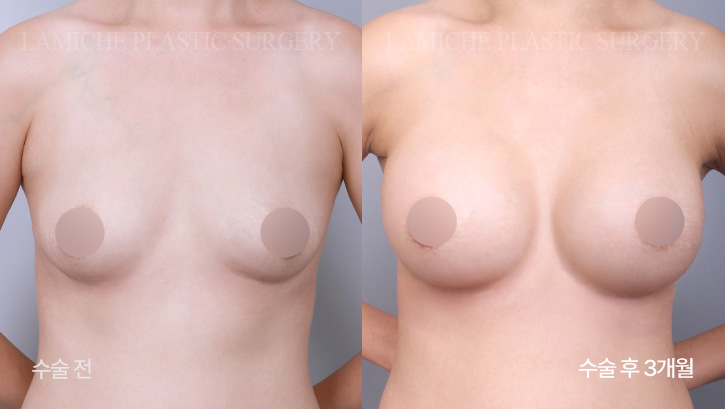 breast-enlargement-bna3-3