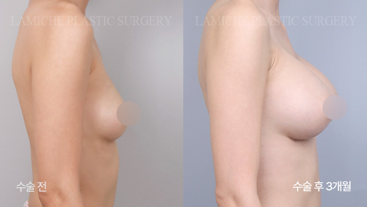 breast-enlargement-bna4-1