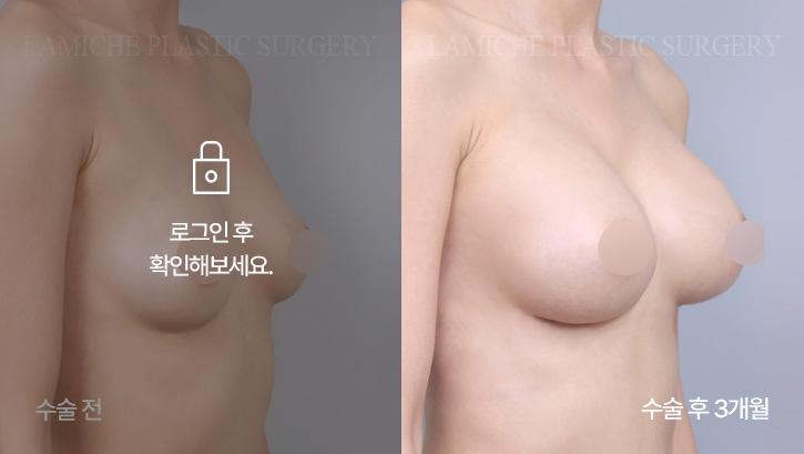 breast-enlargement-bna4-2-