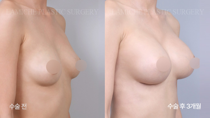 breast-enlargement-bna4-2