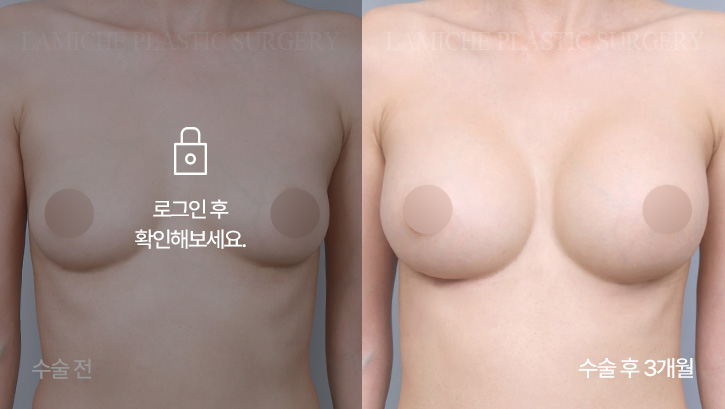 breast-enlargement-bna4-3-