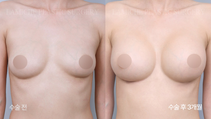 breast-enlargement-bna4-3