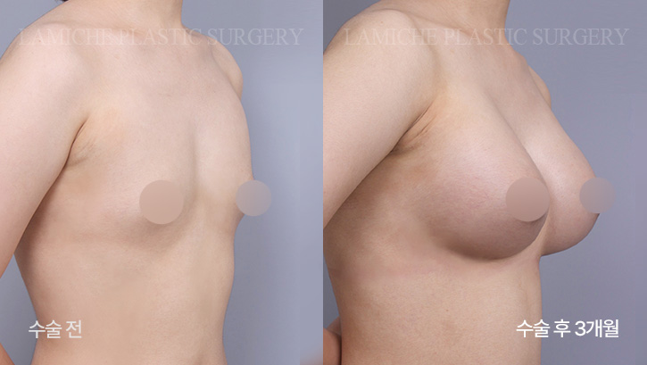 breast-enlargement-bna6-2