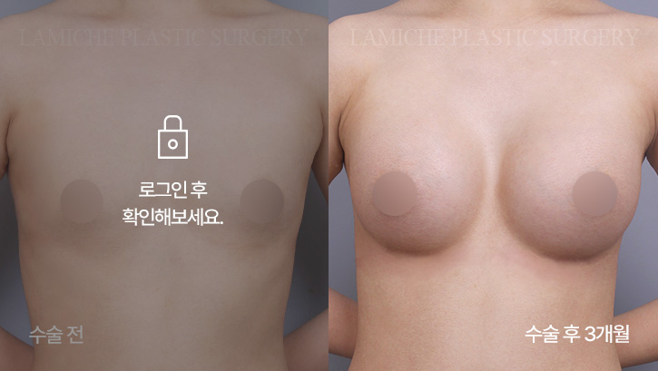 breast-enlargement-bna6-3-