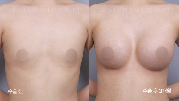 breast-enlargement-bna6-3