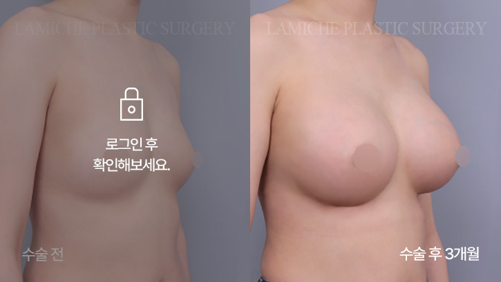 breast-enlargement-bna7-1-