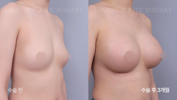 breast-enlargement-bna7-1