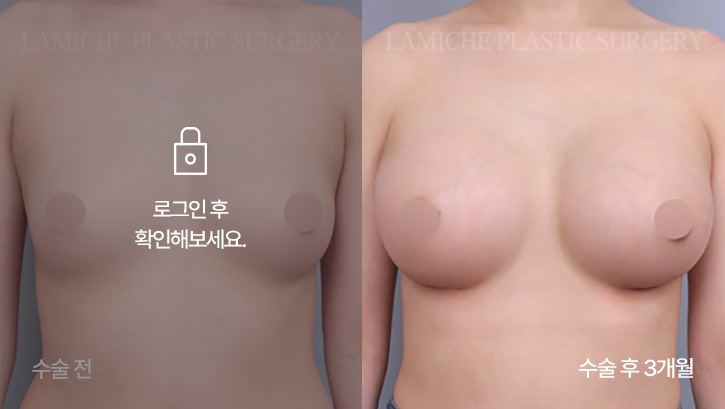 breast-enlargement-bna7-2-