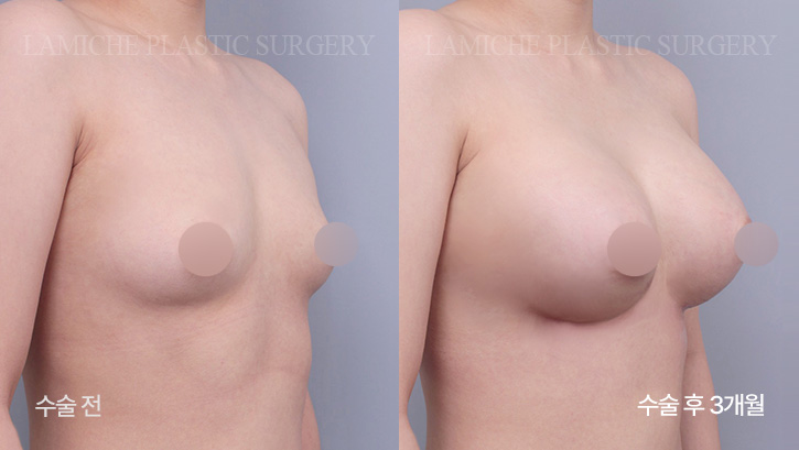 breast-enlargement-bna8-2