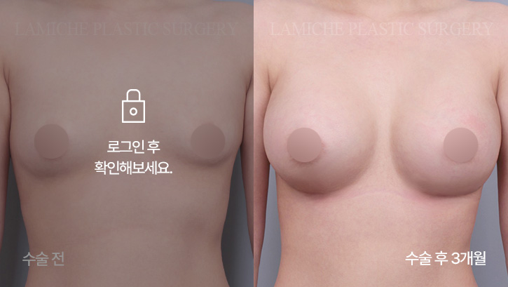 breast-enlargement-bna8-3-