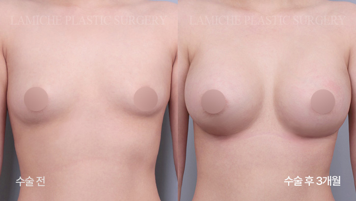 breast-enlargement-bna8-3