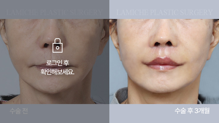 breast-philtrum-bna1-1-