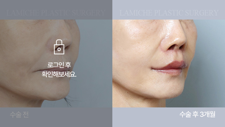 breast-philtrum-bna1-2-