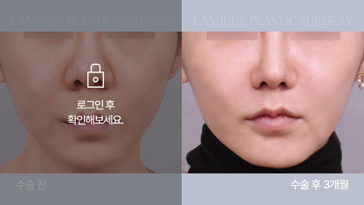 breast-philtrum-bna2-1-