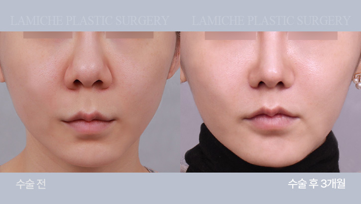 breast-philtrum-bna2-1