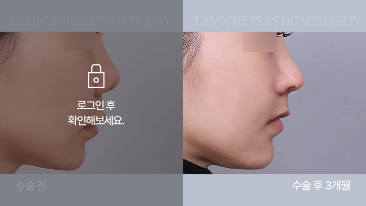 breast-philtrum-bna2-2-