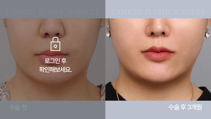 breast-philtrum-bna4-1-