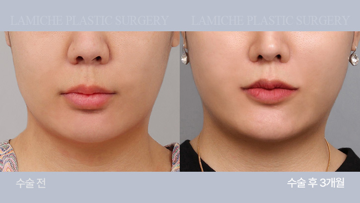 breast-philtrum-bna4-1