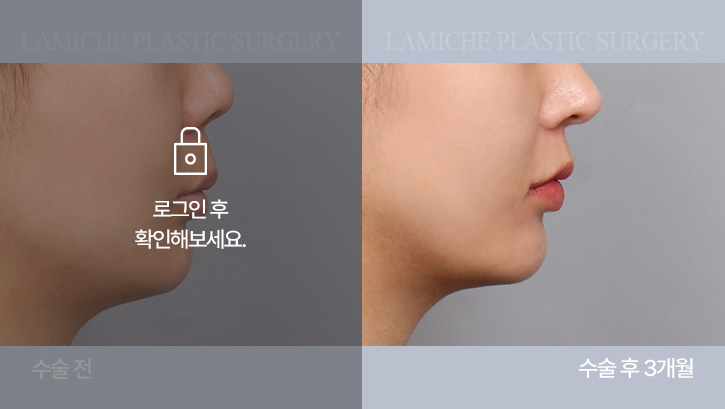 breast-philtrum-bna4-2-