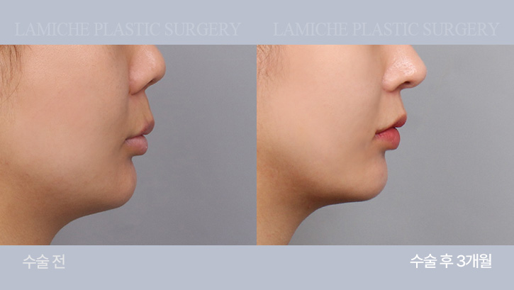 breast-philtrum-bna4-2